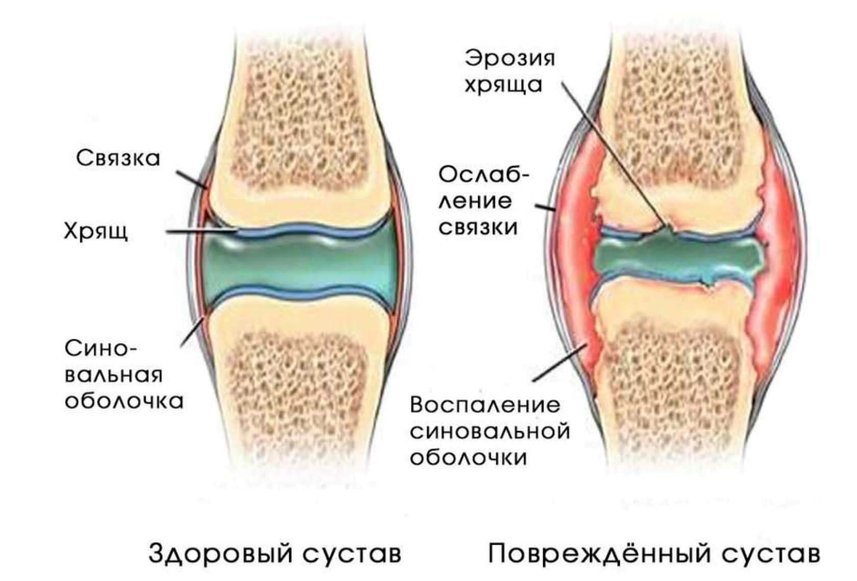 Как выглядит синовит