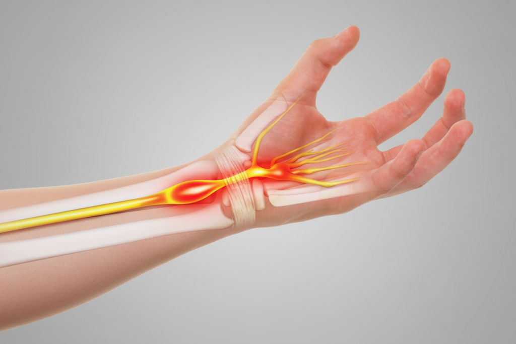 Карпальный туннельный синдром_1.png