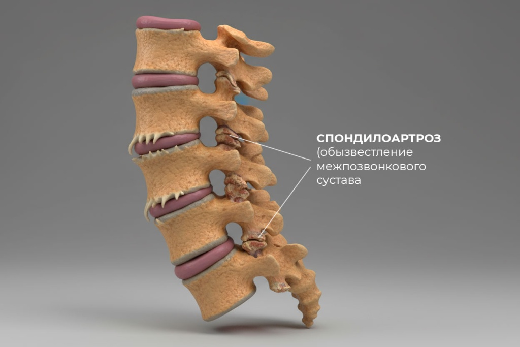 Спондилоартроз.jpg Спондилоартроз.jpg