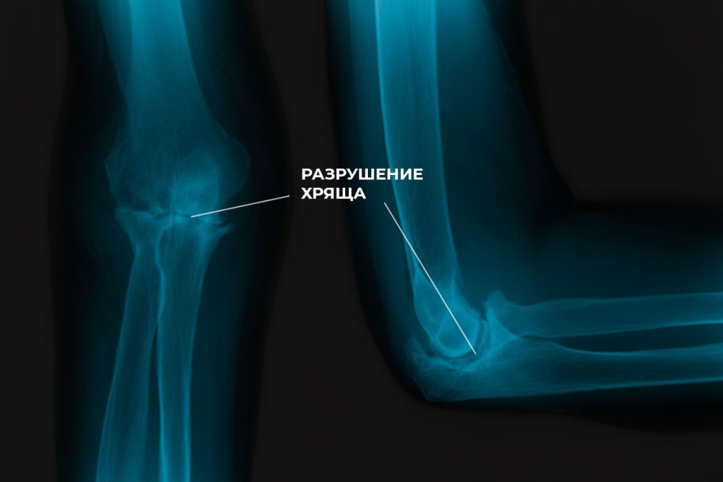 Артроз-локтевого-сустава_3.jpg Артроз-локтевого-сустава_3.jpg