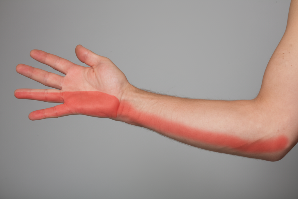 Кубитальный туннельный синдром_2.png Кубитальный туннельный синдром_2.png