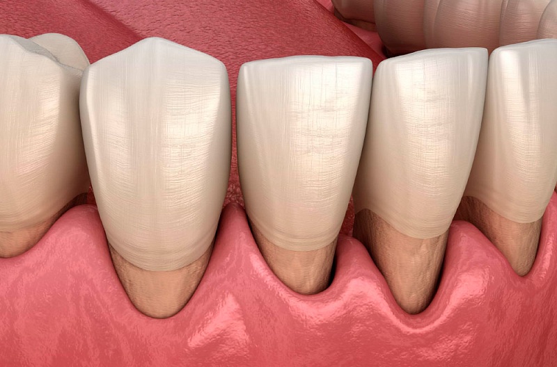 Лечение некариозных поражений зубов